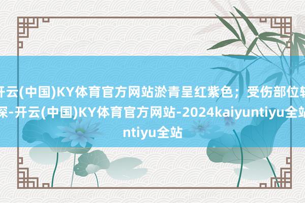 开云(中国)KY体育官方网站淤青呈红紫色；受伤部位较深-开云(中国)KY体育官方网站-2024kaiyuntiyu全站